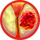 Просталис, Adenofrin, при проблем с простата